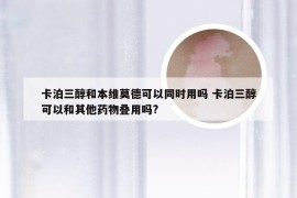 卡泊三醇和本维莫德可以同时用吗 卡泊三醇可以和其他药物叠用吗?