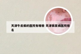 天津牛皮癣的医院有哪些 天津银屑病医院排名