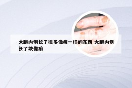 大腿内侧长了很多像癣一样的东西 大腿内侧长了块像癣