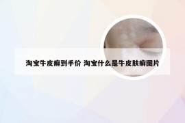 淘宝牛皮癣到手价 淘宝什么是牛皮肤癣图片