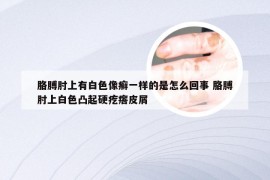 胳膊肘上有白色像癣一样的是怎么回事 胳膊肘上白色凸起硬疙瘩皮屑