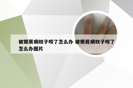 被银屑病蚊子咬了怎么办 被银屑病蚊子咬了怎么办图片