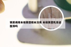银屑病用本维莫德根本没用 本维莫德乳膏进医保吗