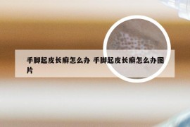 手脚起皮长癣怎么办 手脚起皮长癣怎么办图片