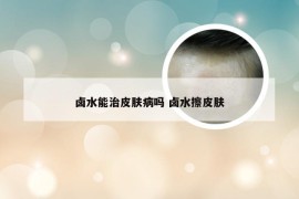 卤水能治皮肤病吗 卤水擦皮肤