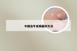 中国治牛皮癣最好方法