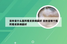 吉林省什么医院看皮肤病最好 吉林省哪个医院看皮肤病最好