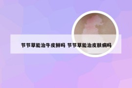节节草能治牛皮鲜吗 节节草能治皮肤病吗