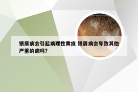 银屑病会引起病理性黄疸 银屑病会导致其他严重的病吗?