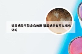 银屑病能不能吃乌鸡汤 银屑病患者可以喝鸡汤吗
