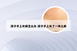 孩子手上长癣怎么办 孩子手上长了一块儿癣