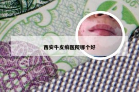 西安牛皮癣医院哪个好