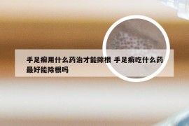 手足癣用什么药治才能除根 手足癣吃什么药最好能除根吗