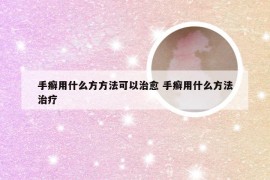 手癣用什么方方法可以治愈 手癣用什么方法治疗