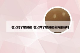 老公的了银屑病 老公得了银屑病会传染我吗