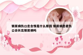 银屑病伤口愈合慢是什么原因 银屑病患者伤口会长出银屑病吗