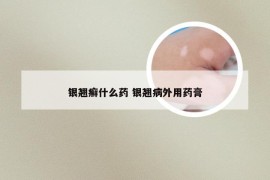 银翘癣什么药 银翘病外用药膏