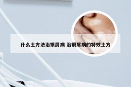 什么土方法治银屑病 治银屑病的特效土方