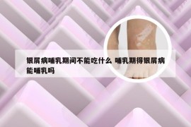 银屑病哺乳期间不能吃什么 哺乳期得银屑病能哺乳吗