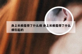 身上长癣是得了什么病 身上长癣是得了什么病引起的