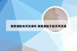 银屑病能每天洗澡吗 银屑病能不能天天洗澡