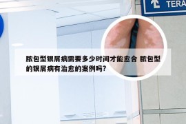 脓包型银屑病需要多少时间才能愈合 脓包型的银屑病有治愈的案例吗?