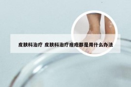 皮肤科治疗 皮肤科治疗痤疮都是用什么办法