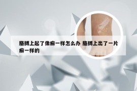 胳膊上起了像癣一样怎么办 胳膊上出了一片癣一样的