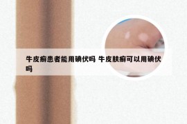 牛皮癣患者能用碘伏吗 牛皮肤癣可以用碘伏吗