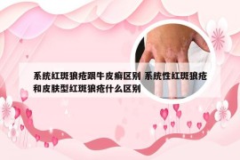 系统红斑狼疮跟牛皮癣区别 系统性红斑狼疮和皮肤型红斑狼疮什么区别
