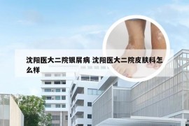 沈阳医大二院银屑病 沈阳医大二院皮肤科怎么样