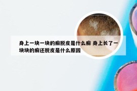 身上一块一块的癣脱皮是什么癣 身上长了一块块的癣还脱皮是什么原因