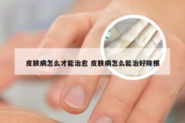 皮肤病怎么才能治愈 皮肤病怎么能治好除根