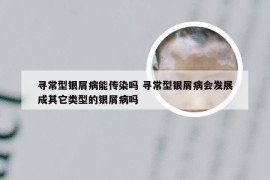 寻常型银屑病能传染吗 寻常型银屑病会发展成其它类型的银屑病吗