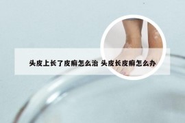头皮上长了皮癣怎么治 头皮长皮癣怎么办