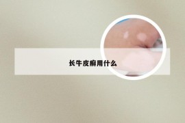 长牛皮癣用什么