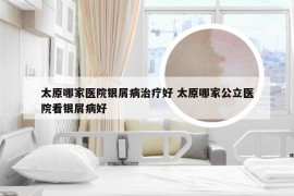 太原哪家医院银屑病治疗好 太原哪家公立医院看银屑病好