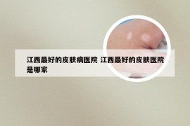 江西最好的皮肤病医院 江西最好的皮肤医院是哪家