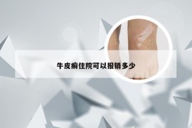 牛皮癣住院可以报销多少