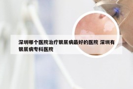 深圳哪个医院治疗银屑病最好的医院 深圳有银屑病专科医院