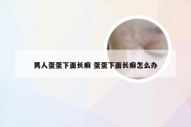 男人蛋蛋下面长癣 蛋蛋下面长癣怎么办