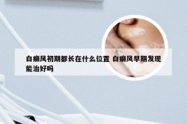 白癞风初期都长在什么位置 白癞风早期发现能治好吗