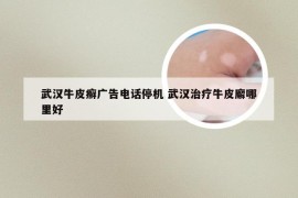 武汉牛皮癣广告电话停机 武汉治疗牛皮廨哪里好