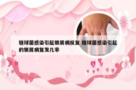 链球菌感染引起银屑病反复 链球菌感染引起的银屑病复发几率