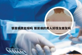 银屑病男能嫁吗 银屑病的男人好找女朋友吗