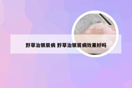 野草治银屑病 野草治银屑病效果好吗
