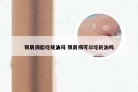 银屑病能吃蚝油吗 银屑病可以吃耗油吗