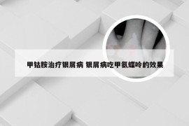 甲钴胺治疗银屑病 银屑病吃甲氨蝶呤的效果