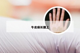 牛皮癣长腰上