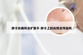 脖子白癜风会扩散不 脖子上的白斑会传染吗